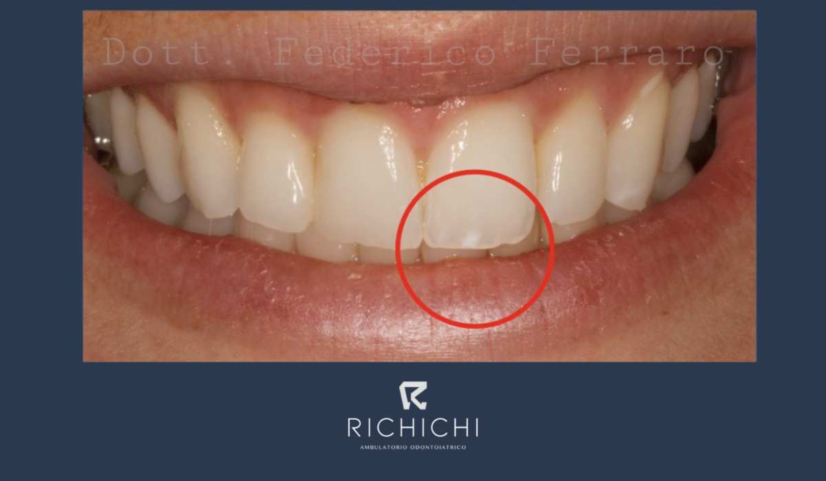 Ambulatorio Richichi MACCHIE BIANCHE SUI DENTI: LA TECNICA NON INVASIVA ...